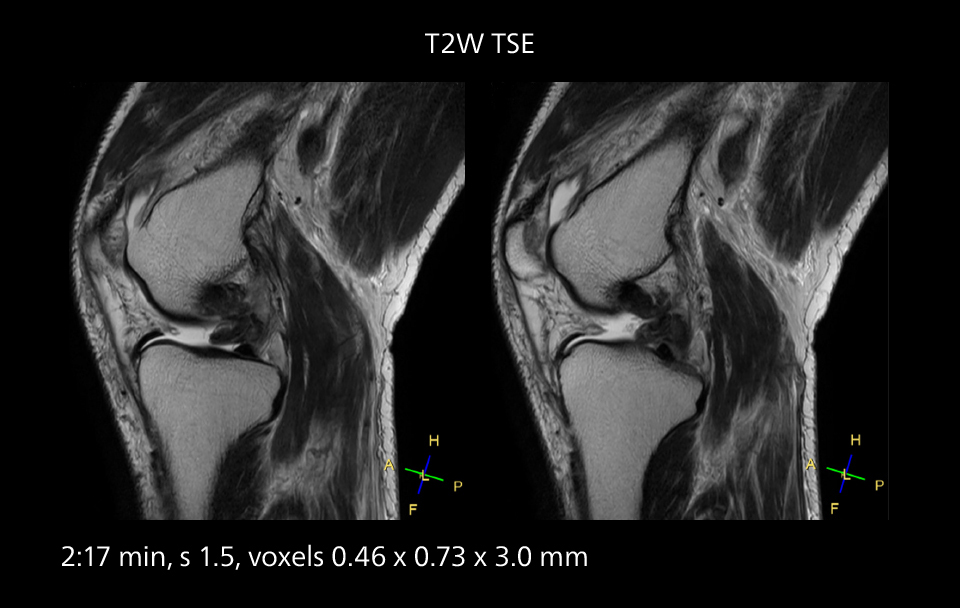 Knee mri three