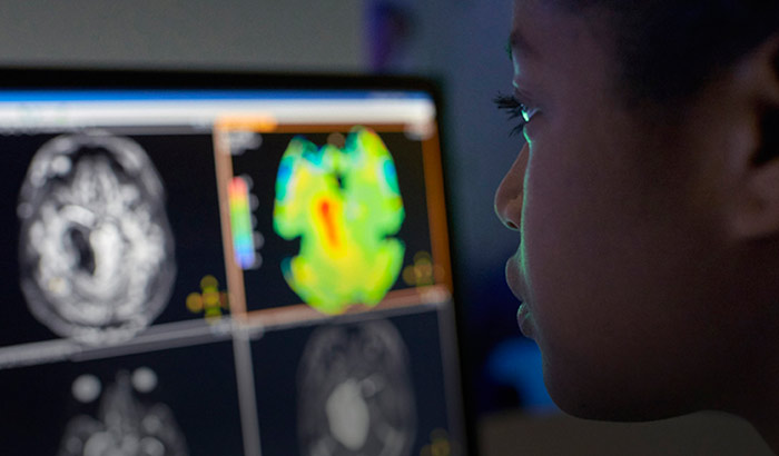 brain tumor mri home_700-375