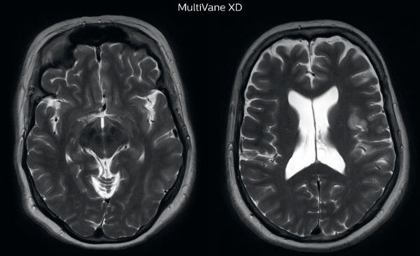 UVM case 2 motion artifact MultivaneXD